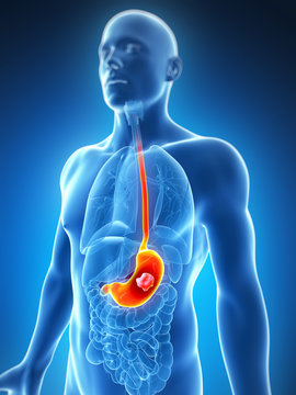 3d rendered illustration of the male stomach - cancer