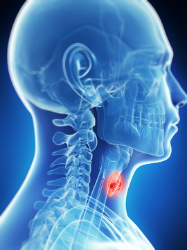 3d rendered illustration of the male thyroid gland - cancer