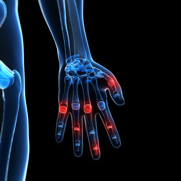 3d rendered illustration of painful finger joints