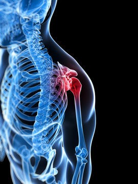 3d rendered illustration of a painful shoulder