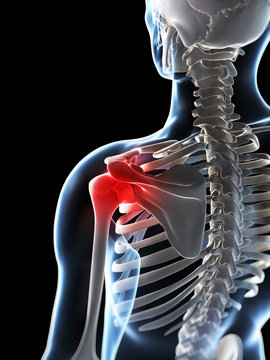 3d rendered illustration of a painful shoulder