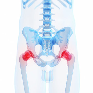 3d rendered illustration of a painful hip joint