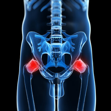 3d rendered illustration of a painful hip joint