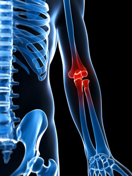3d rendered illustration of a painful elbow