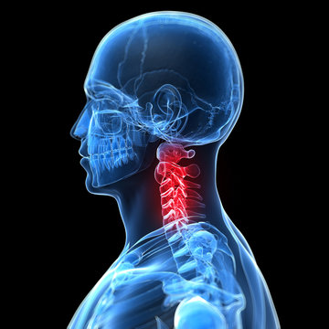 3d rendered illustration of a painful neck