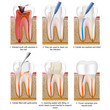 root canal treatment english description, tooth 3 of 5
