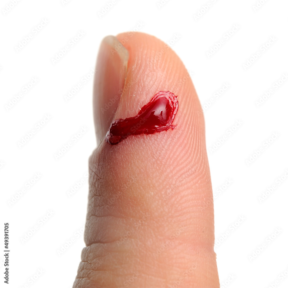 Slashed Bleeding Bleeding from Cut Finger Stock Photo | Adobe Stock