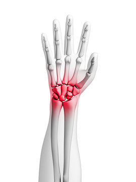3d rendered illustration - painful wrist