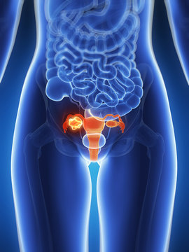 3d rendered illustration - uterus cancer