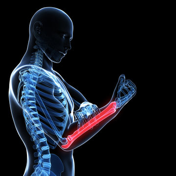 3d rendered illustration - painful arm