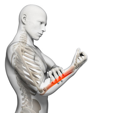 3d rendered illustration - painful arm
