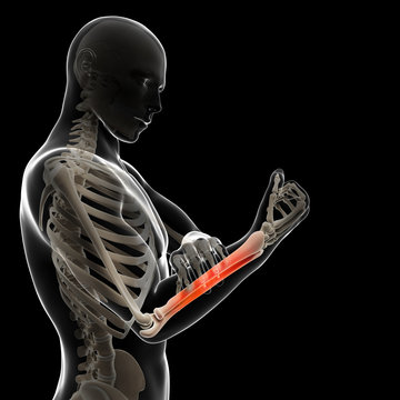 3d rendered illustration - painful arm