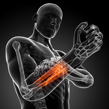 3d rendered illustration - painful arm