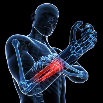 3d rendered illustration - painful arm