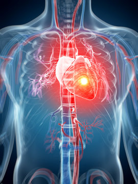 3d rendered illustration - heart attack