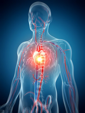 3d rendered illustration - heart attack