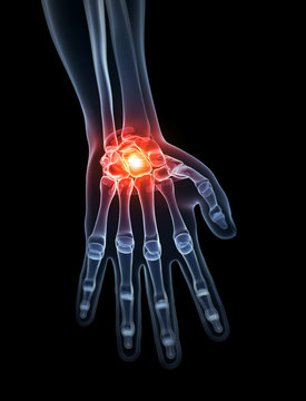3d rendered illustration - painful wrist