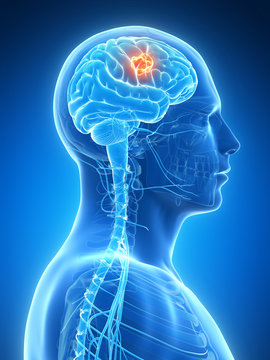 3d rendered illustration - brain tumor