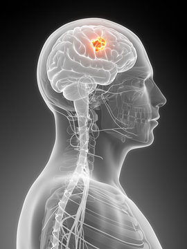 3d rendered illustration - brain tumor