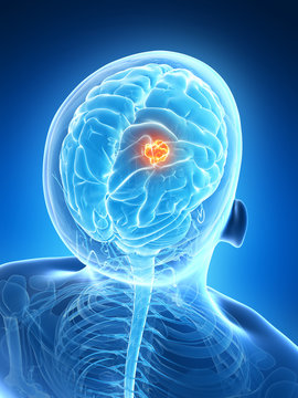 3d rendered illustration - brain tumor