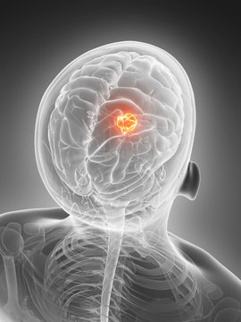3d rendered illustration - brain tumor