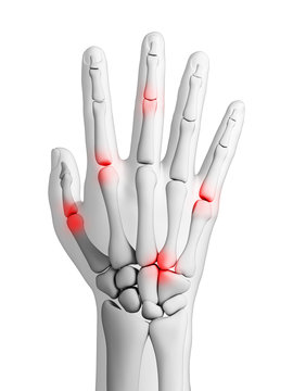 3d rendered illustration - arthritis