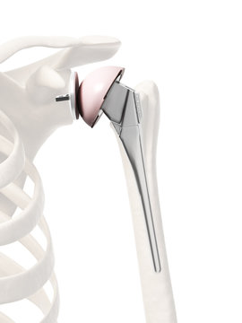 3d rendered illustration of a shoulder replacement