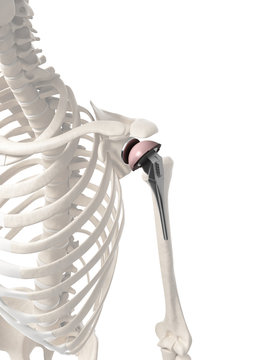 3d rendered illustration of a shoulder replacement