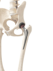 Poster - 3d rendered illustration of a hip replacement