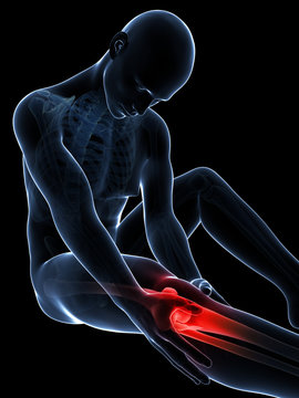 3d rendered illustration of pain in the knee