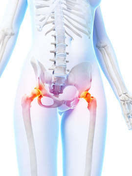3d rendered illustration of painful hip joints