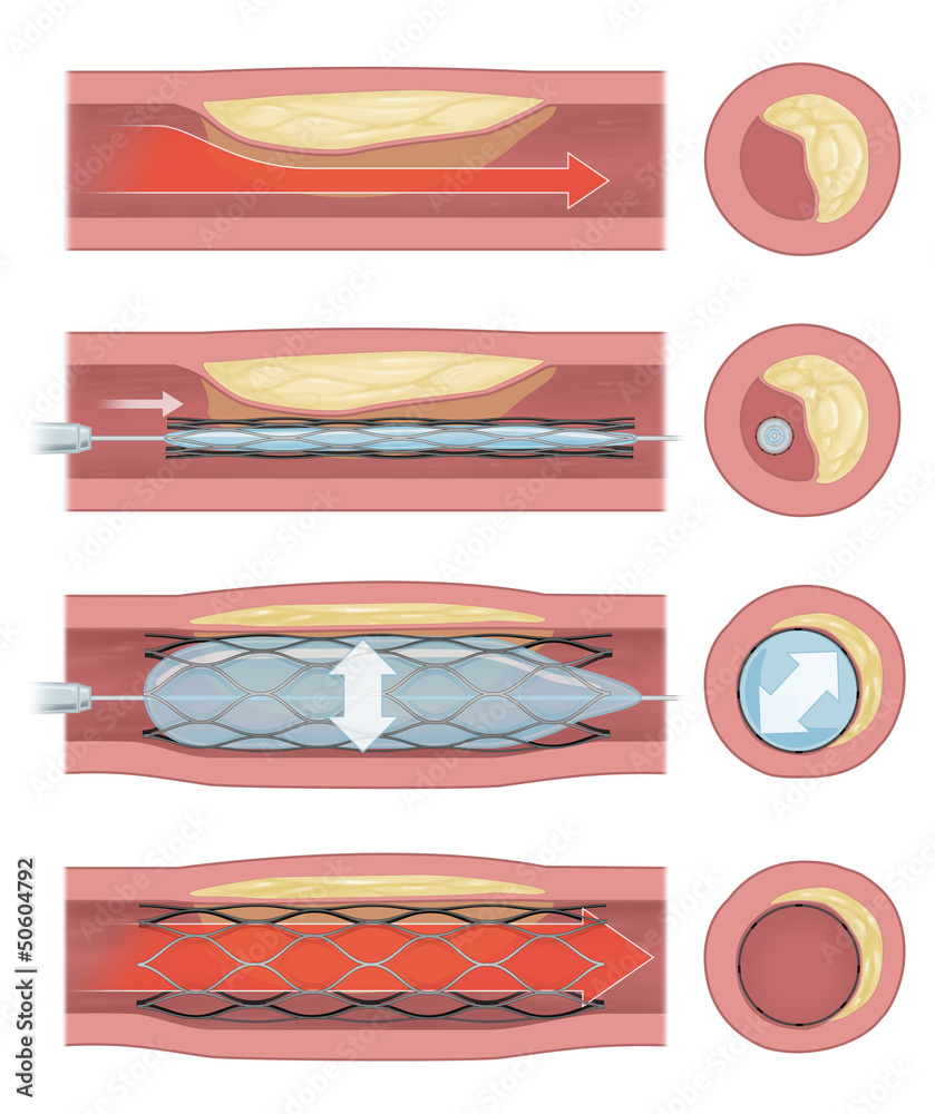 Medical illustration diagram showing the process of coronary