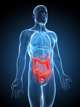3d rendered illustration of an inflamed colon