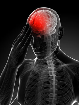 3d rendered conceptual illustration of head pain