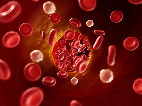 3d rendered illustration of arteriosklerosis