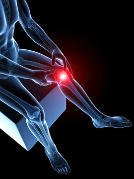 3d rendered medical illustration - painful knee