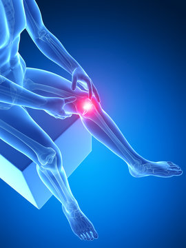 3d rendered medical illustration - painful knee