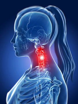 3d rendered medical illustration - painful neck