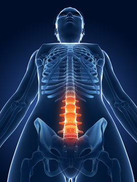 3d rendered medical illustration - painful spine