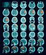 CT scan of the brain. Hemorrhagic stroke.