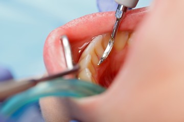 dental calculus removing