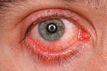 Chronic conjunctivitis eye with red iris and pus close-up.