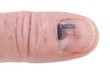 Human finger with black bruised nail isolated