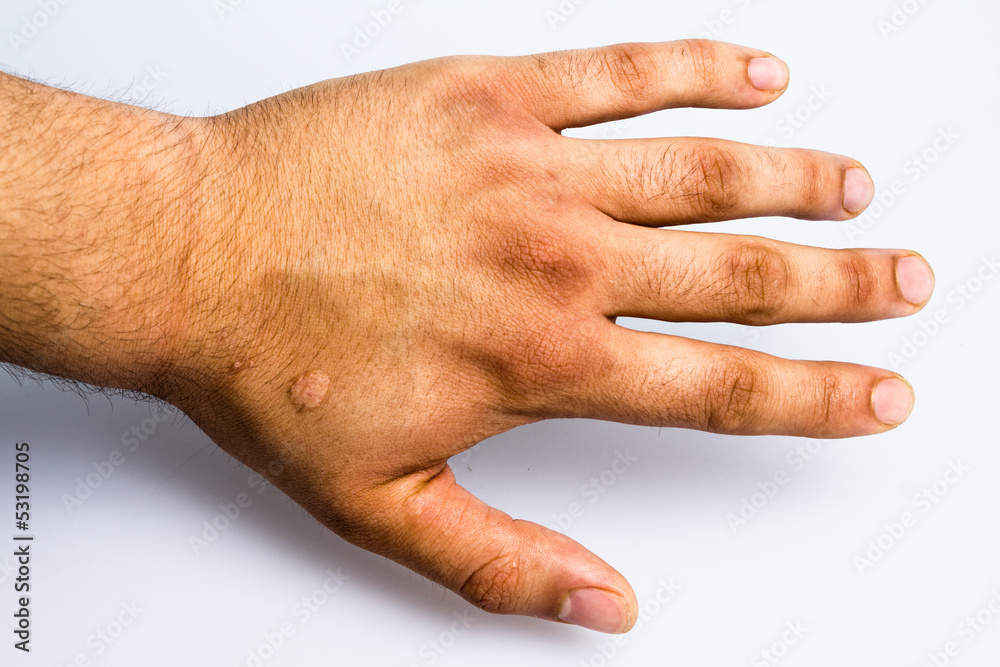 Stockfoto Man's hand with scar from cigarette burn