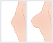 Breast enlargement before and after surgery