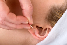 Close-up Of An Acupuncture Needle On An Ear.