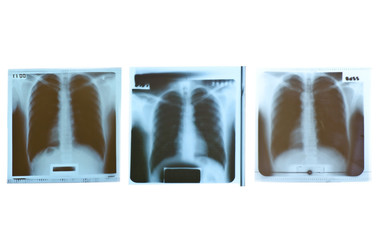 Film x-ray on white background.