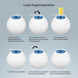 Lasik Augenoperation Funktionsweise
