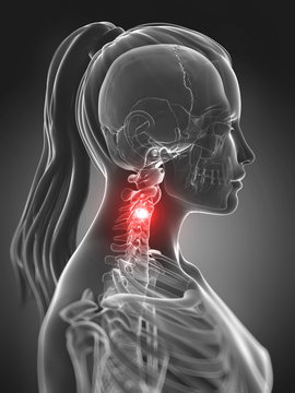 3d rendered illustration of a painful neck