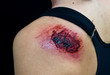open wound on woman shoulder